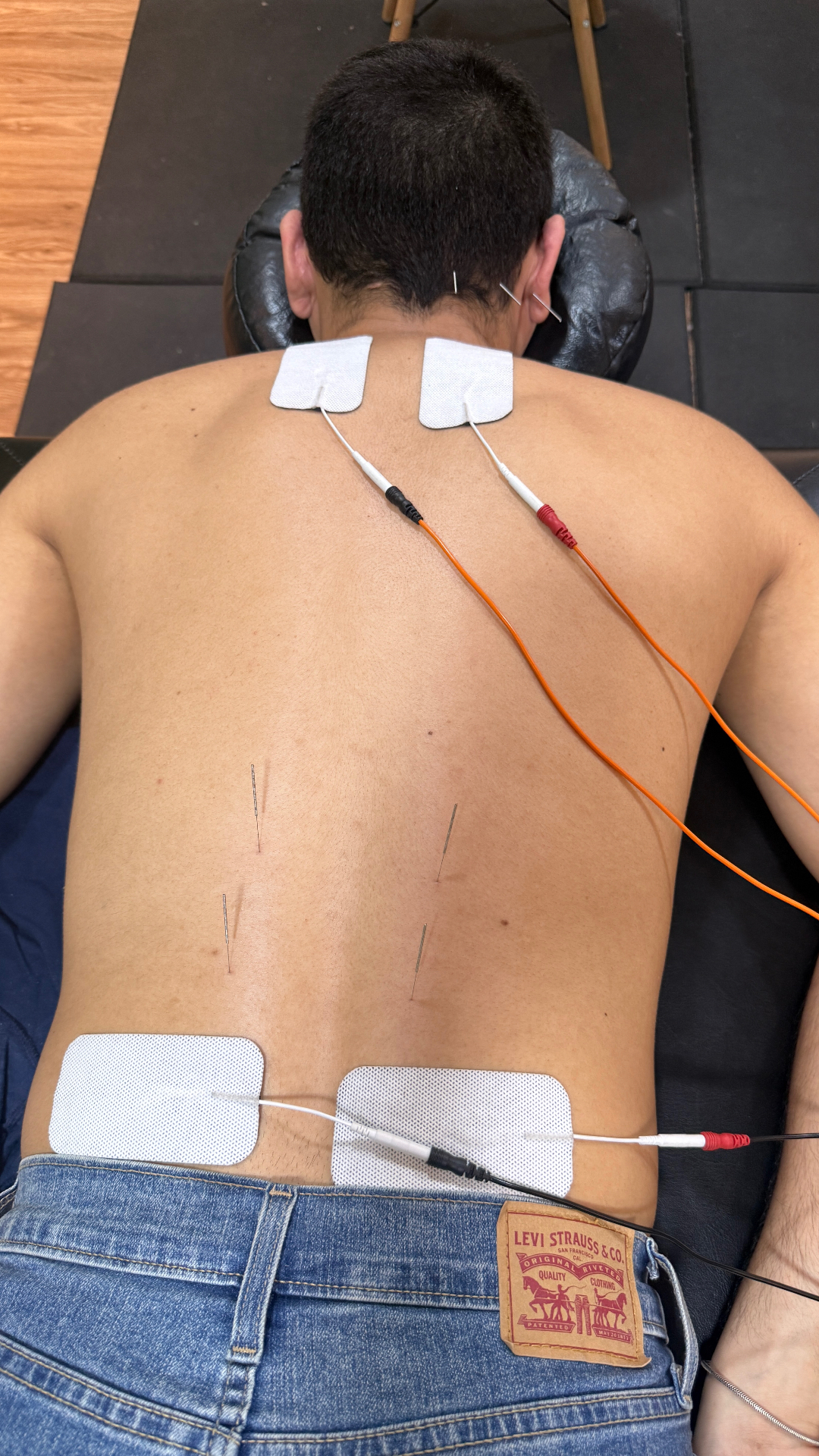 Aplicação de TENS combinada com agulhamento — estimulação elétrica para alívio da dor
